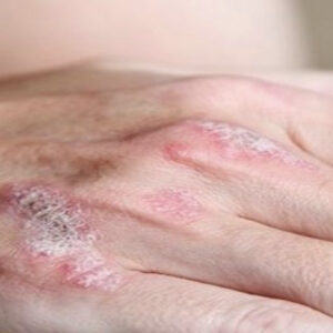 romatoloji uzmani uyariyor sedef romatizmasinda erken tani eklem hasarini onluyor pBB9XYxA