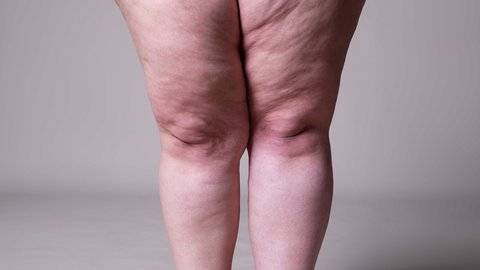 beslenme ve diyet uzmani yurttadur lipodemli bireylerde anti inflamatuar diyet yasam kalitesini artiriyor hlu35Nlz.jpg